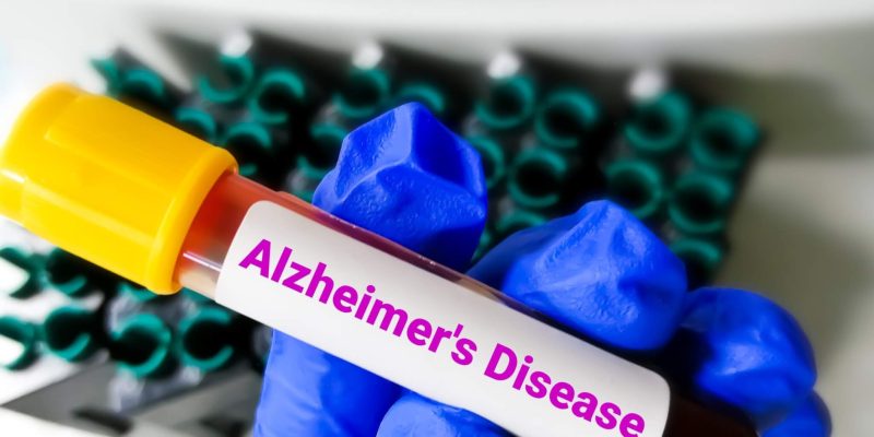 Alzheimers-Blood-Test-scaled.jpg